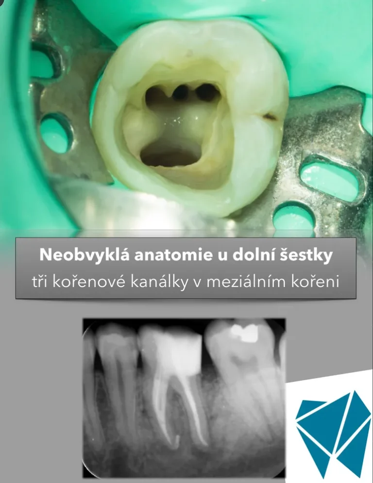 Tři kořenové kanálky v jednom kořeni – ošetřeno pod mikroskopem