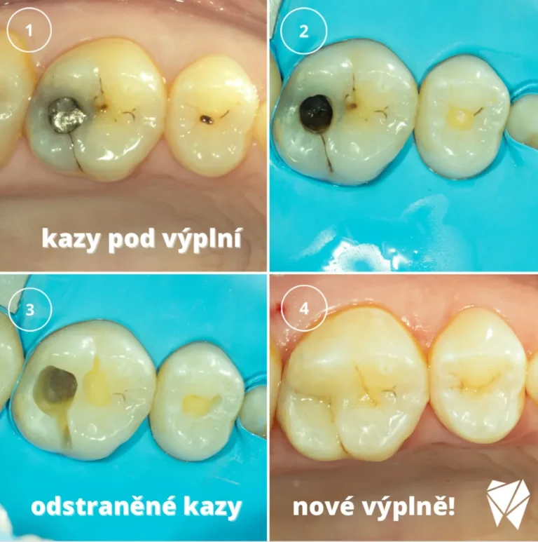 Kazy pod výplní: odstraněné kazy a nové bílé výplně