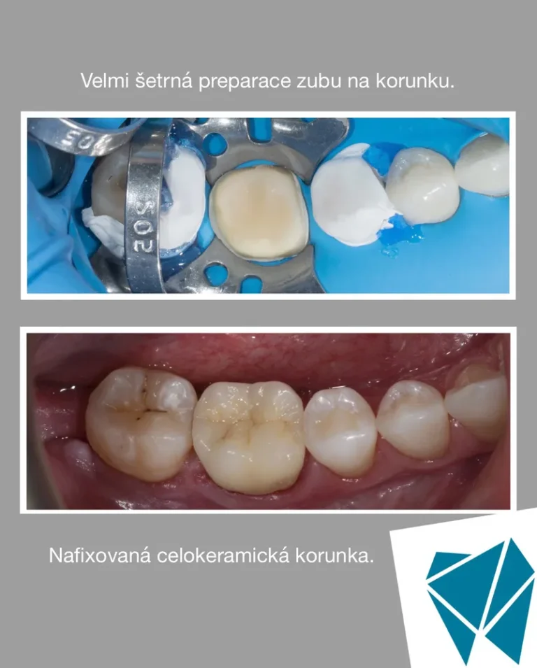 Šetrná preparace a nalícovaná celokeramická korunka