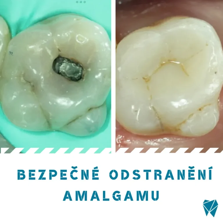 Bezpečné odstranění amalgámu