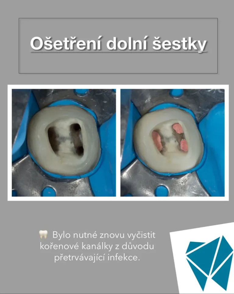 Ošetření dolní šestky